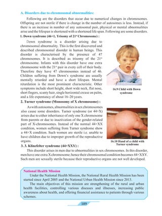 189
1. Down syndrome (46+1, Trisomy of 21st
Chromosome) :
16.10 Hand of a child with
Turner syndrome
A. Disorders due to chromosomal abnormalities:
	 Following are the disorders that occur due to numerical changes in chromosomes.
Offspring are not sterile if there is change in the number of autosomes is less. Instead, if
there is an increase in number of any autosomal pair, physical or mental abnormalities
arise and the lifespan is shortened with a shortened life span. Following are some disorders.
	 Aswithautosomes,abnormalitiesinsexchromosomes
also cause some disorders. Turner syndrome (or 44+X)
arises due to either inheritance of only one X chromosome
from parents or due to inactivation of the gender-related
part of X-chromosomes. Instead of the normal 44+XX
condition, women suffering from Turner syndrome show
a 44+X condition. Such women are sterile i.e. unable to
have children due to improper growth of the reproductive
organs.
3. 3. Klinefelter syndrome (44+XXY) :
16.9 Child with Down
syndrome
	 Down syndrome is a disorder arising due to
chromosomal abnormality. This is the first discovered and
described chromosomal disorder in human beings. This
disorder is characterised by the presence of 47
chromosomes. It is described as trisomy of the 21st
chromosome. Infants with this disorder have one extra
chromosome with the 21st
pair in every cell of their body.
Therefore they have 47 chromosomes instead of 46.
Children suffering from Down’s syndrome are usually
mentally retarded and have a short lifespan. Mental
retardation is the most prominent characteristic. Other
symptoms include short height, short wide neck, flat nose,
short fingers, scanty hair, single horizontal crease on palm,
and a life expentancy of about 16–20 years.
2. Turner syndrome (Monosomy of X chromosome) :
	 This disorder arises in men due to abnormalities in sex chromosomes. In this disorder,
men have one extra X chromosome; hence their chromosomal condition becomes 44+XXY.
Such men are sexually sterile because their reproductive organs are not well developed.
National Health Mission
	 Under the National Health Mission, the National Rural Health Mission has been
started since April 2005 and the National Urban Health Mission since 2013.
	 The main objectives of this mission are strengthening of the rural and urban
health facilities, controlling various diseases and illnesses, increasing public
awareness about health, and offering financial assistance to patients through various
schemes.
 