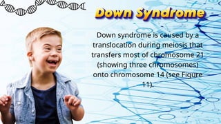 Down syndrome is caused by a
translocation during meiosis that
transfers most of chromosome 21
(showing three chromosomes)
onto chromosome 14 (see Figure
11).
 