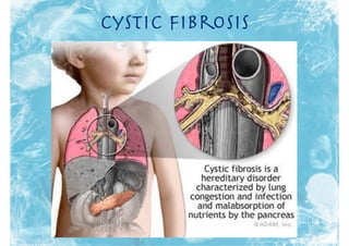 Cystic Fibrosis
 