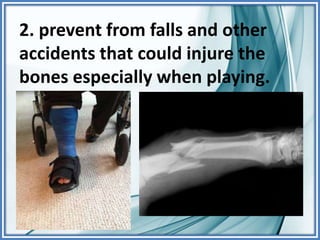 2. prevent from falls and other
accidents that could injure the
bones especially when playing.
 