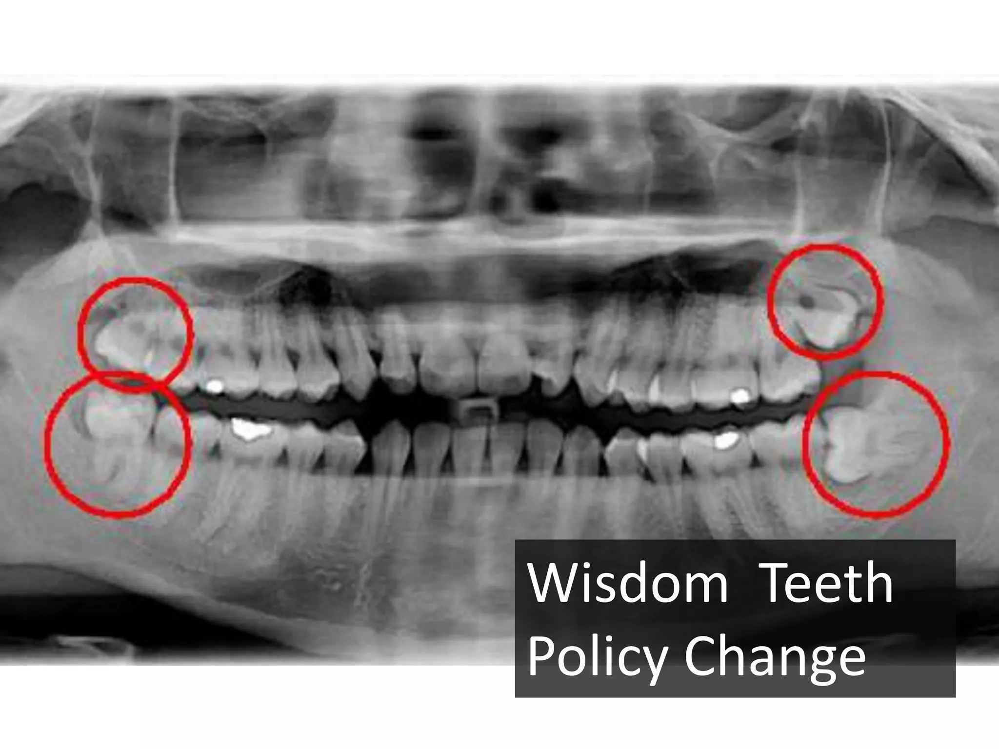 Wisdom Teeth
Policy Change
 