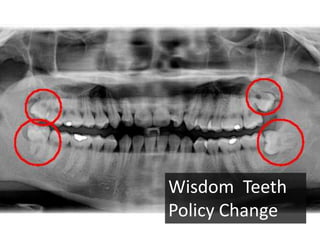 Wisdom Teeth
Policy Change
 
