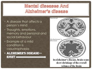 • A disease that affects a
  person’s mind
• Thoughts, emotions,
  memory and personal and
  social behaviour
• Example of a mild
  condition is
  claustrophobia
 
