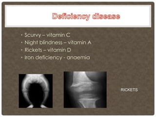 •   Scurvy – vitamin C
•   Night blindness – vitamin A
•   Rickets – vitamin D
•   Iron deficiency - anaemia




                                  RICKETS
 