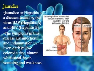 Jaundice
•Jaundice or Hepatitis is
a disease caused by the
virus HAV (Hepatitis A)
and HBV (Hepatitis B).
•The symptoms in this
disease are infection
and inflammation in
liver, dark yellow
colored urine, almost
white stool, fever,
vomiting and weakness.
 