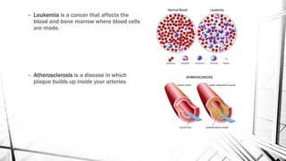 • Leukemia is a cancer that affects the
blood and bone marrow where blood cells
are made.
• Atherosclerosis is a disease in which
plaque builds up inside your arteries
 