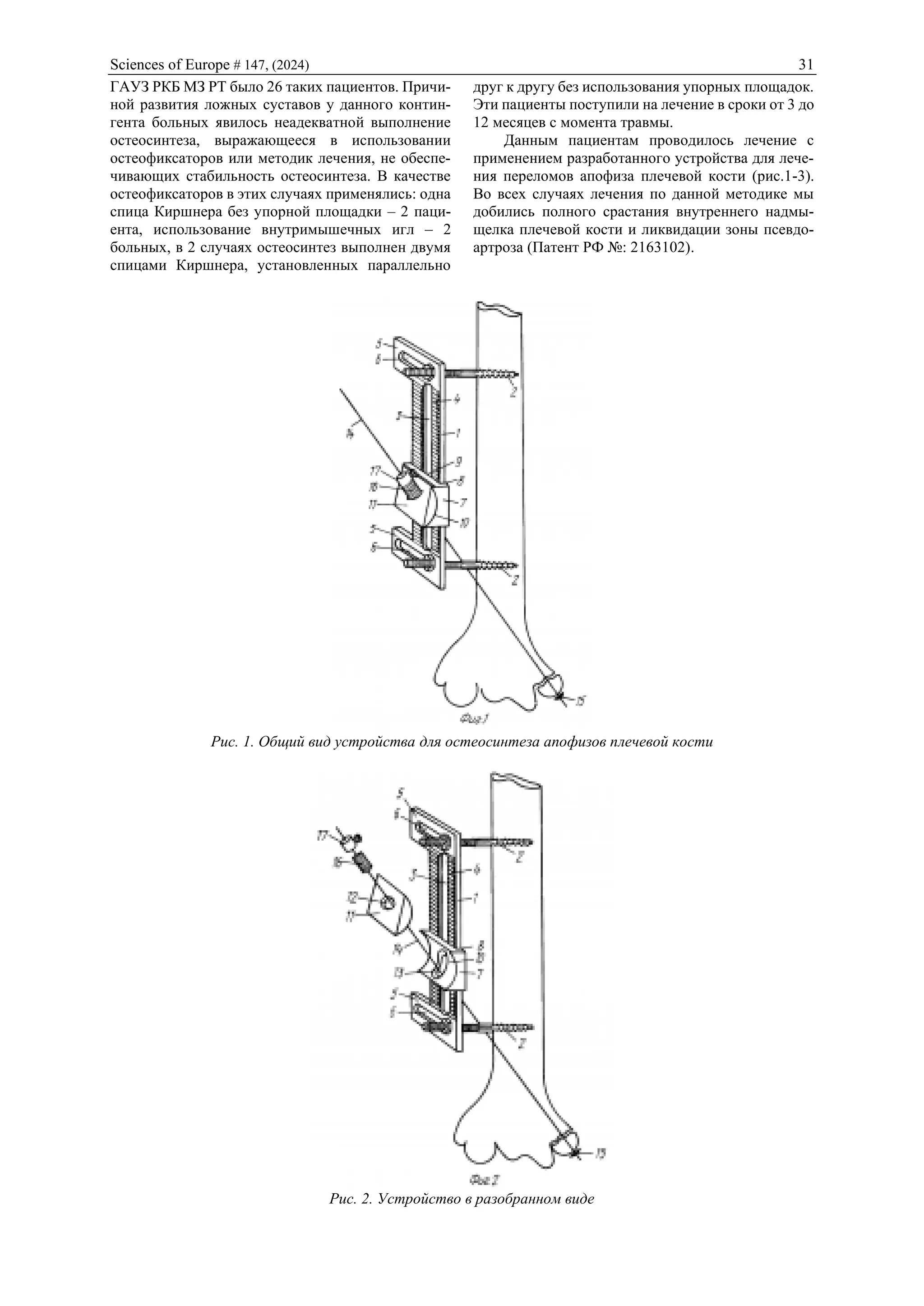 Sciences of Europe # 147, (2024) 31
ГАУЗ РКБ МЗ РТ было 26 таких пациентов. Причи-
ной развития ложных суставов у данного контин-
гента больных явилось неадекватной выполнение
остеосинтеза, выражающееся в использовании
остеофиксаторов или методик лечения, не обеспе-
чивающих стабильность остеосинтеза. В качестве
остеофиксаторов в этих случаях применялись: одна
спица Киршнера без упорной площадки – 2 паци-
ента, использование внутримышечных игл – 2
больных, в 2 случаях остеосинтез выполнен двумя
спицами Киршнера, установленных параллельно
друг к другу без использования упорных площадок.
Эти пациенты поступили на лечение в сроки от 3 до
12 месяцев с момента травмы.
Данным пациентам проводилось лечение с
применением разработанного устройства для лече-
ния переломов апофиза плечевой кости (рис.1-3).
Во всех случаях лечения по данной методике мы
добились полного срастания внутреннего надмы-
щелка плечевой кости и ликвидации зоны псевдо-
артроза (Патент РФ №: 2163102).
Рис. 1. Общий вид устройства для остеосинтеза апофизов плечевой кости
Рис. 2. Устройство в разобранном виде
 