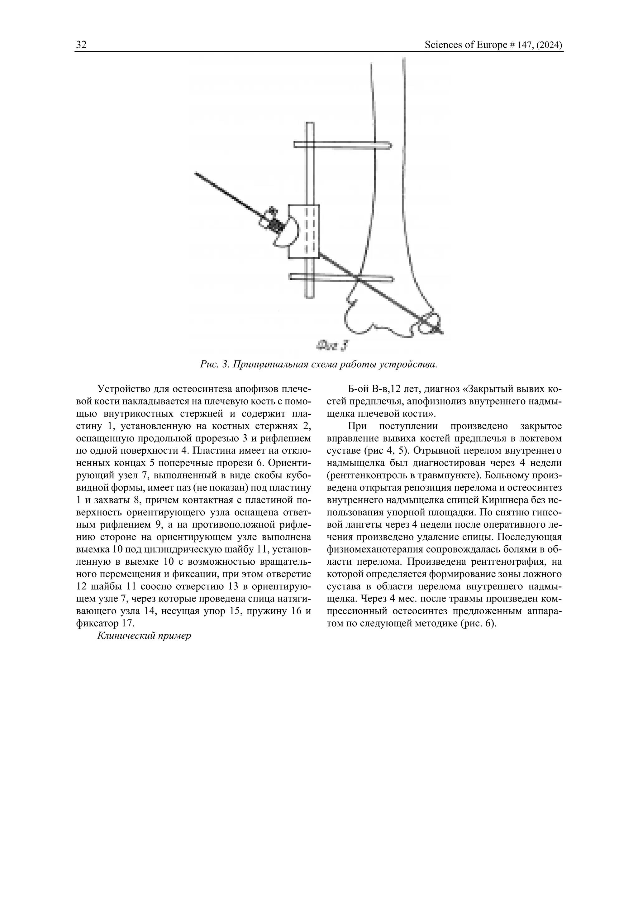 32 Sciences of Europe # 147, (2024)
Рис. 3. Принципиальная схема работы устройства.
Устройство для остеосинтеза апофизов плече-
вой кости накладывается на плечевую кость с помо-
щью внутрикостных стержней и содержит пла-
стину 1, установленную на костных стержнях 2,
оснащенную продольной прорезью 3 и рифлением
по одной поверхности 4. Пластина имеет на откло-
ненных концах 5 поперечные прорези 6. Ориенти-
рующий узел 7, выполненный в виде скобы кубо-
видной формы, имеет паз (не показан) под пластину
1 и захваты 8, причем контактная с пластиной по-
верхность ориентирующего узла оснащена ответ-
ным рифлением 9, а на противоположной рифле-
нию стороне на ориентирующем узле выполнена
выемка 10 под цилиндрическую шайбу 11, установ-
ленную в выемке 10 с возможностью вращатель-
ного перемещения и фиксации, при этом отверстие
12 шайбы 11 соосно отверстию 13 в ориентирую-
щем узле 7, через которые проведена спица натяги-
вающего узла 14, несущая упор 15, пружину 16 и
фиксатор 17.
Клинический пример
Б-ой В-в,12 лет, диагноз «Закрытый вывих ко-
стей предплечья, апофизиолиз внутреннего надмы-
щелка плечевой кости».
При поступлении произведено закрытое
вправление вывиха костей предплечья в локтевом
суставе (рис 4, 5). Отрывной перелом внутреннего
надмыщелка был диагностирован через 4 недели
(рентгенконтроль в травмпункте). Больному произ-
ведена открытая репозиция перелома и остеосинтез
внутреннего надмыщелка спицей Киршнера без ис-
пользования упорной площадки. По снятию гипсо-
вой лангеты через 4 недели после оперативного ле-
чения произведено удаление спицы. Последующая
физиомеханотерапия сопровождалась болями в об-
ласти перелома. Произведена рентгенография, на
которой определяется формирование зоны ложного
сустава в области перелома внутреннего надмы-
щелка. Через 4 мес. после травмы произведен ком-
прессионный остеосинтез предложенным аппара-
том по следующей методике (рис. 6).
 