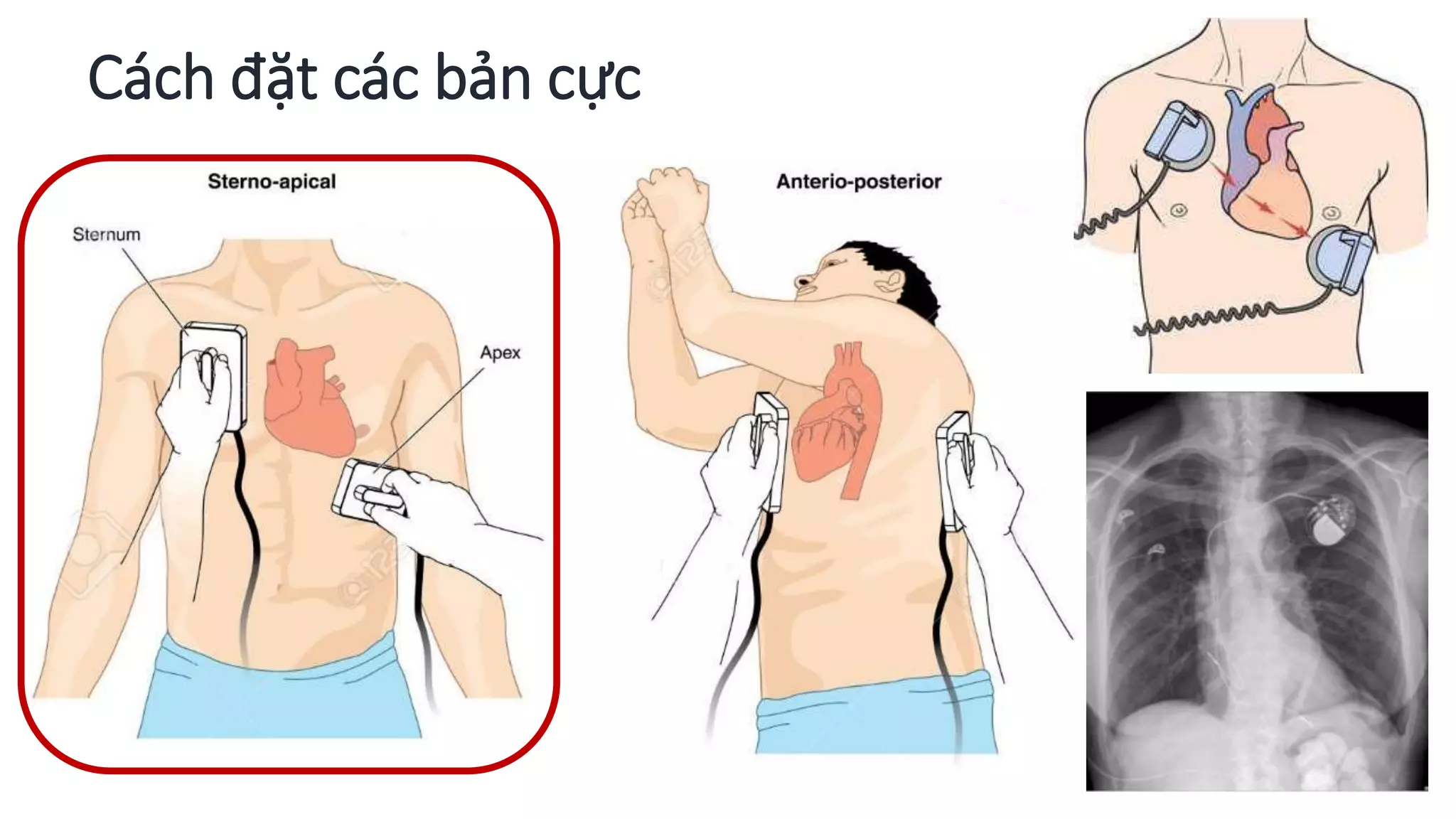 Sốc điện | PPTX