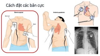Cách đặt các bản cực
 