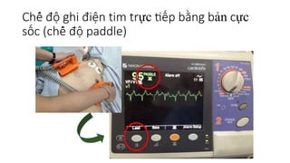 Chế độ ghi điện tim trực tiếp bằng bản cực
sốc (chế độ paddle)
 