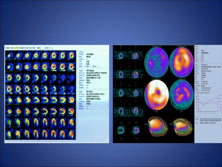 Scintigrafia miocardica perfusionale nella diagnosi di cardiopatia is…
