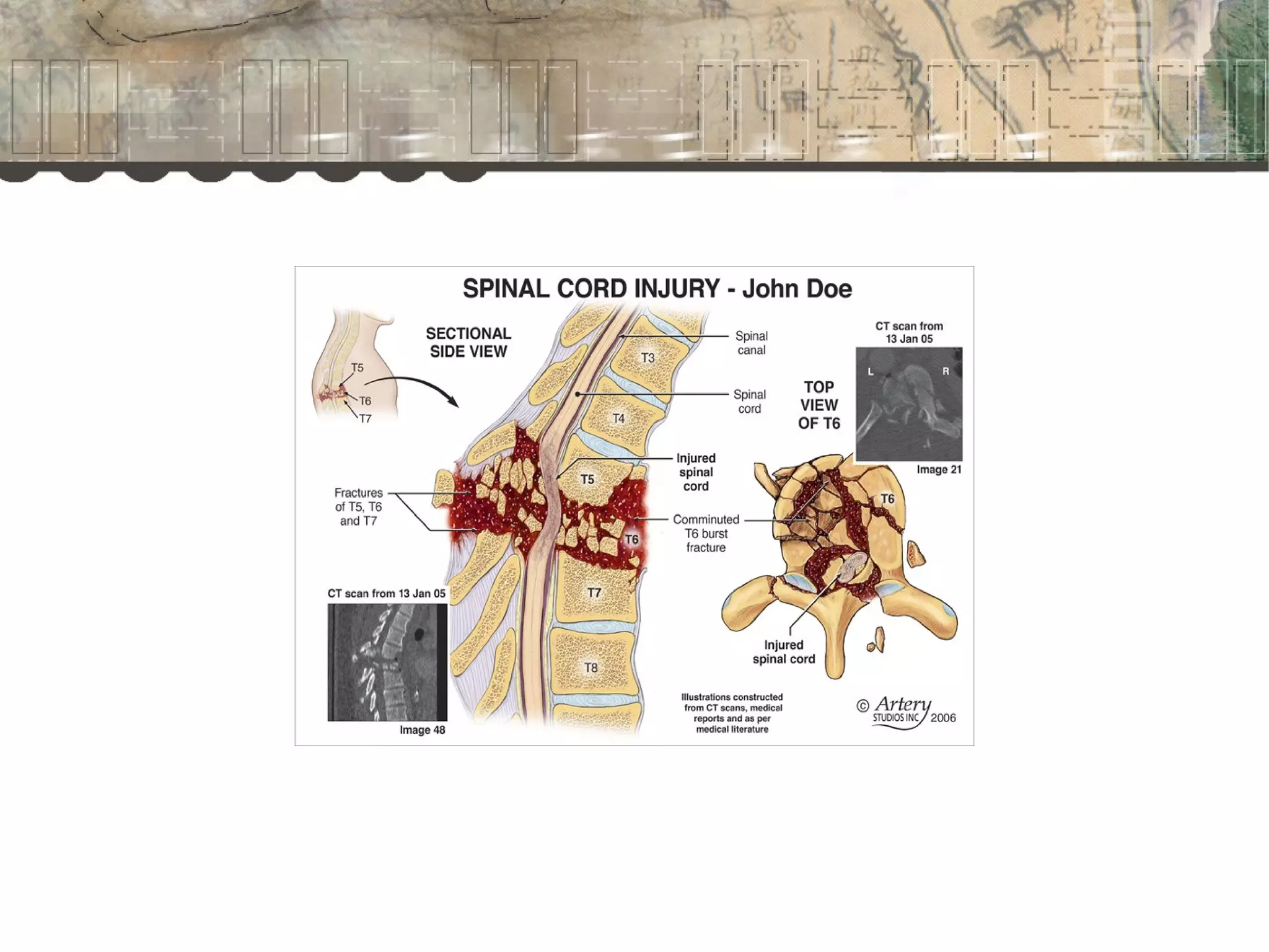 Spinal cord injury | PPT