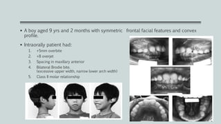  A boy aged 9 yrs and 2 months with symmetric frontal facial features and convex
profile.
 Intraorally patient had:
1. +5mm overbite
2. +8 overjet
3. Spacing in maxillary anterior
4. Bilateral Brodie bite.
(excessive upper width, narrow lower arch width)
5. Class II molar relationship
 