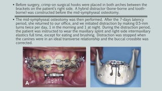 Before surgery, crimp-on surgical hooks were placed in both arches between the
brackets on the patient’s right side. A hybrid distractor (bone-borne and tooth-
borne) was constructed before the mid-symphyseal osteotomy.
 The mid-symphyseal osteotomy was then performed. After the 7-days latency
period, she returned to our office, and we initiated distraction by making 0.5-mm
turns twice per day, 1 in the morning and 1 at night. During the distraction period,
the patient was instructed to wear the maxillary splint and right-side intermaxillary
elastics full time, except for eating and brushing. Distraction was stopped when
the canines were in an ideal transverse relationship and the buccal crossbite was
corrected.
 