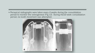  Periapical radiographs were taken every 4 weeks during the consolidation
period to monitor the osteogenesis (Fig 13). During the10-week consolidation
period, no tooth movement was attempted.
 