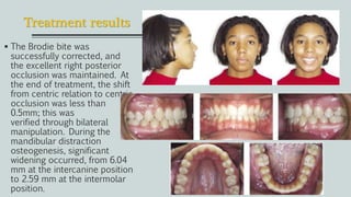 Treatment results
 The Brodie bite was
successfully corrected, and
the excellent right posterior
occlusion was maintained. At
the end of treatment, the shift
from centric relation to centric
occlusion was less than
0.5mm; this was
verified through bilateral
manipulation. During the
mandibular distraction
osteogenesis, significant
widening occurred, from 6.04
mm at the intercanine position
to 2.59 mm at the intermolar
position.
 