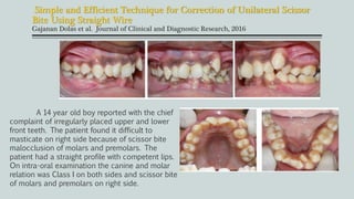 Simple and Efficient Technique for Correction of Unilateral Scissor
Bite Using Straight Wire
Gajanan Dolas et al. Journal of Clinical and Diagnostic Research, 2016
A 14 year old boy reported with the chief
complaint of irregularly placed upper and lower
front teeth. The patient found it difficult to
masticate on right side because of scissor bite
malocclusion of molars and premolars. The
patient had a straight profile with competent lips.
On intra-oral examination the canine and molar
relation was Class I on both sides and scissor bite
of molars and premolars on right side.
 