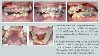 Treatment plan and progress
 The wire without making arch form was
placed such that its one side was engaged
on left sided molar tube, and the other side
was engaged on the molar tube on scissor
bite side.
An acrylic bite block was placed on left side;
to reinforce the anchorage from molars and
premolars on one side to relieve the scissor
bite on other side. It was based on the
concept of using light continuous force.
 