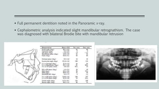  Full permanent dentition noted in the Panoramic x-ray.
 Cephalometric analysis indicated slight mandibular retrognathism. The case
was diagnosed with bilateral Brodie bite with mandibular retrusion
 