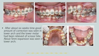  After about six weeks time good
amount of correction was seen in
lower arch and the lower molar
had been relieved of scissor bite.
About 5mm expansion was seen in
lower arch.
 