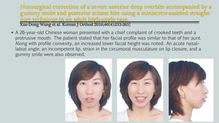 Nonsurgical correction of a severe anterior deep overbite accompanied by a
gummy smile and posterior scissor bite using a miniscrew-assisted straight-
wire technique in an adult high-angle case.
Xue-Dong Wang et al. Korean J Orthod 2016;46(4):253-265]
 A 26-year-old Chinese woman presented with a chief complaint of crooked teeth and a
protrusive mouth. The patient stated that her facial profile was similar to that of her aunt.
Along with profile convexity, an increased lower facial height was noted. An acute nasal–
labial angle, an incompetent lip, strain in the circumoral musculature on lip closure, and a
gummy smile were also observed.
 