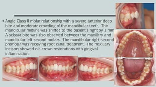  Angle Class II molar relationship with a severe anterior deep
bite and moderate crowding of the mandibular teeth. The
mandibular midline was shifted to the patient’s right by 1 mm.
A scissor bite was also observed between the maxillary and
mandibular left second molars. The mandibular right second
premolar was receiving root canal treatment. The maxillary
incisors showed old crown restorations with gingival
inflammation.
 