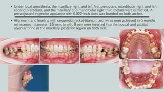  Under local anesthesia, the maxillary right and left first premolars, mandibular right and left
second premolars, and the maxillary and mandibular right third molars were extracted. A
pre-adjusted edgewise appliance with 0.022-inch slots was bonded on both arches.
 Alignment and leveling with sequential nickel-titanium archwires were achieved in 6 months
miniscrews diameter, 1.5 mm; length, 8 mm were inserted into the buccal and palatal
alveolar bone in the maxillary posterior region on both side.
 