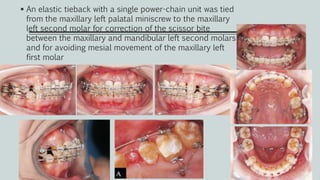  An elastic tieback with a single power-chain unit was tied
from the maxillary left palatal miniscrew to the maxillary
left second molar for correction of the scissor bite
between the maxillary and mandibular left second molars
and for avoiding mesial movement of the maxillary left
first molar
 