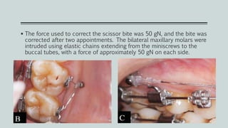 The force used to correct the scissor bite was 50 gN, and the bite was
corrected after two appointments. The bilateral maxillary molars were
intruded using elastic chains extending from the miniscrews to the
buccal tubes, with a force of approximately 50 gN on each side.
 