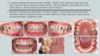 A classic sliding mechanism with a 0.019 . 0.025- inch stainless steel archwire
was used for space closure in both arches. All the tiebacks were placed on the
miniscrews to avoid mesial movement of the molars.
 Another 2 miniscrews (diameter, 1.5 mm; length, 7 mm) were inserted into the
maxillary anterior alveolar bone on both sides for incisor intrusion, with a force
of approximately 50 gN per side.
 