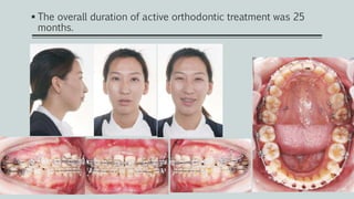 The overall duration of active orthodontic treatment was 25
months.
 