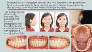  The gummy smile is
dramatically
improved. The
post-treatment
intraoral
photographs show
Class I molar and
canine relationships
with normalized
overjet and overbite
Facial and intraoral photographs obtained after final restorations. The posttreatment
facial photographs show the facial esthetics has been obviously improved with the
chin deficiency corrected and the lower facial height decreased.
 