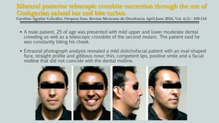 Bilateral posterior telescopic crossbite correction through the use of
Goshgarian palatal bar and bite turbos.
Carolina Aguilar González, Oropeza Sosa. Revista Mexicana de Ortodoncia April-June 2016, Vol. 4,(2) : 109-116
 A male patient, 25 of age was presented with mild upper and lower moderate dental
crowding as well as a telescopic crossbite of the second molars. The patient said he
was constantly biting his cheek.
 Extraoral photograph analysis revealed a mild dolichofacial patient with an oval-shaped
face, straight profile and gibbous nose; thin, competent lips, positive smile and a facial
midline that did not coincide with the dental midline.
 