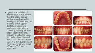  Upon intraoral clinical
examination it was noted:
that the upper dental
midline was deviated to
the right and the lower, to
the left; a mild upper
dental crowding and
moderate lower dental
crowding, labially inclined
upper second molars,
lingually positioned lower
second molars, bilateral
molar class III and canine
class I; 2 mm overbite and
1.5 mm overjet and curve
of Spee of 3.5 mm on
both sides.
 