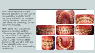 Next step in treatment was the
alternate activation on each side of
the palatal bar and after eight
months of activation we managed
to bring the second molars into
their basal arch obtaining a 54 mm
transverse distance.
At the same time, the archwire
sequence indicated by Roth
philosophy was followed in both
arches until the final stage of
treatment was completed with
0.019” x 0.025” stainless steel
archwires. The use of ¼ inch and
3.5 oz class III elastics was
instructed for a better intermaxillary
relationship
 
