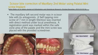  The maxillary left second molar was in scissor
bite with its antagonists. A Self tapping mini
screw of 7 mm in length (Dentos) was inserted
with direct method under local anesthesia. A
registration point was marked within the safe
zone area of the palate and the mini screw was
placed with the provided screwdriver.
Scissor bite correction of Maxillary 2nd Molar using Palatal Mini
screw Implant
Neetu Dabla, et al. Indian Journal of Orthodontics and Dentofacial Research, October-December, 2015;1(1):32-34
 