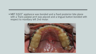  MBT 0.022" appliance was bonded and a fixed posterior bite plane
with a Trans palatal arch was placed and a lingual button bonded with
respect to maxillary left 2nd molar.
 