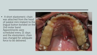  A short elastomeric chain
was attached from the head
of palatal mini-implant to the
lingual button bonded on the
2nd molar band.
Appointments were
scheduled every 21 days
and the elastomeric chain
was changed for adequate
force to be delivered.
 