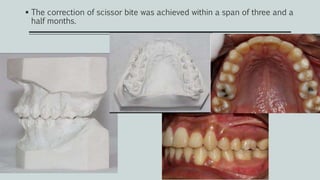  The correction of scissor bite was achieved within a span of three and a
half months.
 