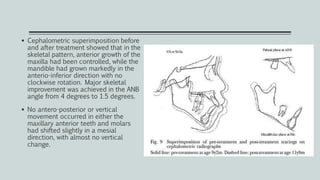  Cephalometric superimposition before
and after treatment showed that in the
skeletal pattern, anterior growth of the
maxilla had been controlled, while the
mandible had grown markedly in the
anterio-inferior direction with no
clockwise rotation. Major skeletal
improvement was achieved in the ANB
angle from 4 degrees to 1.5 degrees.
 No antero-posterior or vertical
movement occurred in either the
maxillary anterior teeth and molars
had shifted slightly in a mesial
direction, with almost no vertical
change.
 