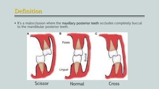 Definition
 It’s a malocclusion where the maxillary posterior teeth occludes completely buccal
to the mandibular posterior teeth.
Scissor Normal Cross
 