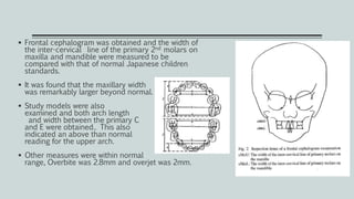  Frontal cephalogram was obtained and the width of
the inter-cervical line of the primary 2nd molars on
maxilla and mandible were measured to be
compared with that of normal Japanese children
standards.
 It was found that the maxillary width
was remarkably larger beyond normal.
 Study models were also
examined and both arch length
and width between the primary C
and E were obtained.. This also
indicated an above than normal
reading for the upper arch.
 Other measures were within normal
range, Overbite was 2.8mm and overjet was 2mm.
 