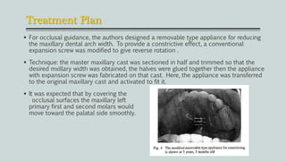 Treatment Plan
 For occlusal guidance, the authors designed a removable type appliance for reducing
the maxillary dental arch width. To provide a constrictive effect, a conventional
expansion screw was modified to give reverse rotation .
 Technique: the master maxillary cast was sectioned in half and trimmed so that the
desired mxillary width was obtained, the halves were glued together then the appliance
with expansion screw was fabricated on that cast. Here, the appliance was transferred
to the original maxillary cast and activated to fit it.
 It was expected that by covering the
occlusal surfaces the maxillary left
primary first and second molars would
move toward the palatal side smoothly.
 