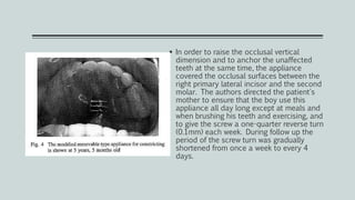  In order to raise the occlusal vertical
dimension and to anchor the unaffected
teeth at the same time, the appliance
covered the occlusal surfaces between the
right primary lateral incisor and the second
molar. The authors directed the patient's
mother to ensure that the boy use this
appliance all day long except at meals and
when brushing his teeth and exercising, and
to give the screw a one-quarter reverse turn
(0.1mm) each week. During follow up the
period of the screw turn was gradually
shortened from once a week to every 4
days.
 