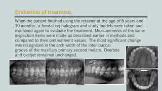 Evaluation of treatment.
When the patient finished using the retainer at the age of 6 years and
10 months , a frontal cephalogram and study models were taken and
examined again to evaluate the treatment. Measurements of the same
inspection items were made as described earlier in methods and
compared to their pretreatment values. The most significant change
was recognized in the arch width of the inter-buccal
groove of the maxillary primary second molars. Overbite
and overjet remained unchanged.
 