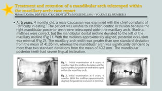 Treatment and retention of a mandibular arch telescoped within
the maxillary arch: case report
Milton E. Gellin, DDS PEDIATRIC DENTISTRY: MAY/JUNE, 1991 ~ VOLUME 13, NUMBER 3
 At 6 years, 4 months old, a male Caucasian was examined with the chief complaint of
"difficulty in eating." The patient was unable to establish centric occlusion because the
right mandibular posterior teeth were telescoped within the maxillary arch. Skeletal
midlines were correct, but the mandibular dental midline deviated to the left of the
maxillary midline (Fig 1). With the midlines approximately aligned, posterior occlusion
was minimal (Fig 2). The maxillary arch width was greater than one standard deviation
from the mean of 41.85mm, whereas the mandibular arch was significantly deficient by
more than two standard deviations from the mean of 40.2 mm. The mandibular
posterior teeth had severe lingual inclination.
 