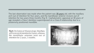 The last observation was made when the patient was 18 years old, with the maxillary
arch out of retention for four years, and the mandibular anterior incisors out of
retention for two years three months (Fig 4). Cephalometric appraisal at 18 years of
age revealed a Class I dentition superimposed on a Class II relationship due to a
posteriorly positioned mandible.
 