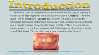 When one tooth or several teeth are positioned more buccally or lingually in
relation to the opposing teeth, the malocclusion is called “Crossbite”. The more
severe form of crossbite is “Scissors-bite” in which in habitual occlusion the
mandibular dentition is contained in the maxillary arch. Scissors-bite may develop
from a maxillary buccal or mandibular lingual crossbite. When scissors-bite on
multiple molars is a result of transverse skeletal discrepancy, the malocclusion is
termed “Brodie bite.” Scissors-bite may appear as unilateral or bilateral.
Treatment of a Bilateral Scissors-Bite in an Adolescent With Fixed Appliances Ahmad Sodaga et al. Iran J Ortho. In
Press; online 2016 May 30.
 
