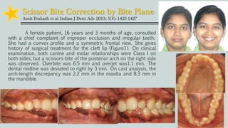 Scissor Bite Correction by Bite Plane
Amit Prakash et al Indian J Dent Adv 2013; 5(4): 1425-1427
A female patient, 16 years and 3 months of age, consulted
with a chief complaint of improper occlusion and irregular teeth.
She had a convex profile and a symmetric frontal view. She gives
history of surgical treatment for the cleft lip (Figure1). On clinical
examination, both canine and molar relationships were Class I on
both sides, but a scissors-bite of the posterior arch on the right side
was observed. Overbite was 6.5 mm and overjet was1.1 mm. The
dental midline was deviated to right by 3 mm. On cast analysis, the
arch-length discrepancy was 2.2 mm in the maxilla and 8.3 mm in
the mandible.
 